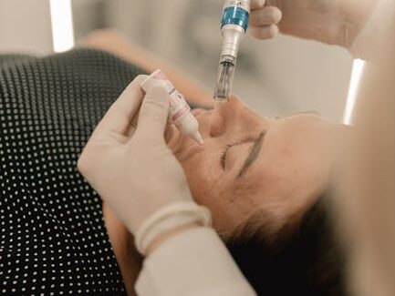 Close-up of person receiving microneedling beauty treatment in a clinic.